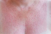 Sun Rash: What to Know About Photosensitivity - Water's Edge Dermatology