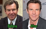 Dennis Quaid Plastic Surgery: Botox and Eye Lift? Before-After Photos ...