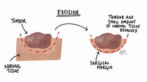 Excision | MyPathologyReport.ca