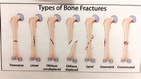 Types of Bone Fractures guide : coolguides