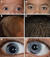 Waardenburg Syndrome | Allergy and Clinical Immunology | JAMA ...