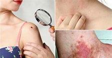 7 Síntomas del cáncer de piel y cómo prevenir la enfermedad