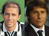 Antonio Conte: il trapianto di capelli dell'allenatore di calcio