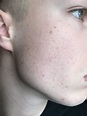 Ice pick scars? - Scar treatments - Acne.org