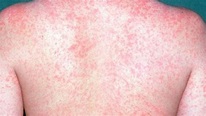 Measles outbreak has affected 107 people in 21 states, including ...