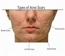 From Ice pick scars to Hyperpigmentation: Treat Acne Scars Naturally ...