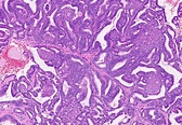 Pathology Outlines - Endometrioid carcinoma