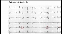 Extrasistole Auricular EKG - YouTube