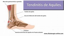 Tendinitis del tendón de Aquiles: causas, síntomas y tratamiento ...