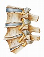Neuroforaminal Spinal Stenosis | Spinal arthritis, Degenerative disc ...