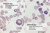 Babesia spp. on Peripheral Blood Smear Microscopy ... | GrepMed
