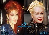 Cyndi Lauper Plastic Surgery Before and After Photos - Plastic Surgery ...