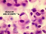 Carcinoma de Células em Anel de Sinete