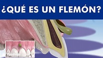 El absceso dental - Qué es un FLEMÓN y cómo se cura la infección con pus © - YouTube