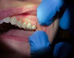Flemón dental | las causas, tratamiento y más información - Clínica ...