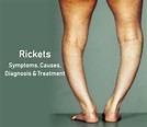Rickets: Symptoms, Causes, Diagnosis & Treatment » CashKaro Blog