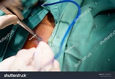 Excision Biopsy Procedure Elliptical Incision Using Stock Photo ...