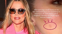 Khloé Kardashian Gives Update After Removal of Facial Tumor: 'I'm ...