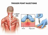 Trigger Point Injections | The Spine & Rehab Group