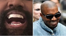 Kanye West Replaces Teeth with $850,000 Titanium Dentures