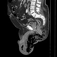 Fournier gangrene | Radiology Reference Article | Radiopaedia.org