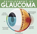 Glaucoma - Conoce más sobre el glaucoma y cómo tratarlo / European ...