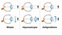 Miopia e hipermetropia — guia completo sobre as diferenças!