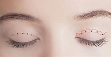 縫雙眼皮手術 - 菲仕美整形外科診所