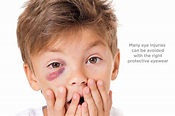What to Do for a Black Eye - Optometrists.org