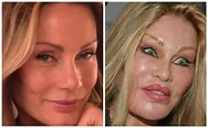 Plastic Surgery Catwoman Before And After