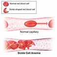 Sickle cell disease - Wikipedia
