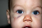 ...and baby makes FOUR: First Black Eye