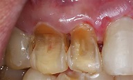 6 Causas de la EROSIÓN DENTAL – Clínica Dental Noemi Crespo