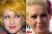 Cyndi Lauper Plastic Surgery Before And After Pictures | 2018 Plastic ...