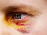 How To Get Rid Of A Black Eye Naturally | Healthankering.com