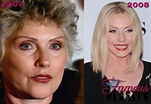 Debbie Harry Plastic Surgery Before and After Facelift, Brow lift and ...