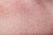 Zika Virus Rash- Symptoms, Treatments, Causes, & Preventions