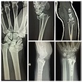Collection 93+ Pictures Closed Fracture Of Distal End Of Left Fibula ...