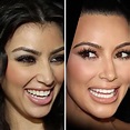 Antes y después Todas las operaciones de Kim Kardashian: antes y ...