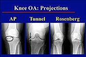 Rosenberg position is most sensitive for diagnosing osteoarthritis ...