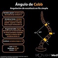 Ángulo de Cobb:Angulación de escoliosis en Rx simple. Fuente ...