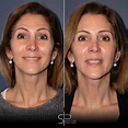 Botox antes y después | Todo lo que necesitas saber antes de hacerlo (2022)