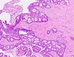 Adenocarcinoma Colon Histology