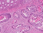 Adenocarcinoma invasivo de colon y recto | MyPathologyReport.ca