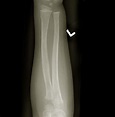Greenstick Fracture - Pictures, Treatment, Symptoms, Healing Time, Causes | HubPages