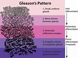 Gleason grading system - Wikipedia
