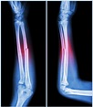 Bone Fracture: Who’s Vulnerable? And How Can You Lower Your Risk? - University Health News