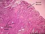 Pathology of Adenocarcinoma-Colon - Pathology Made Simple