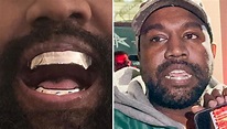 Kanye West seemingly replaces teeth with $13.9m titanium dentures