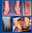 CLUBFOOT - FOOT AND ANKLE DEFORMITIES - Principles and Management of ...